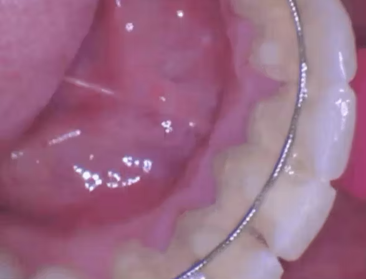 Case lâm sàng về cạo vôi kết hợp đánh bóng bằng bột glycine